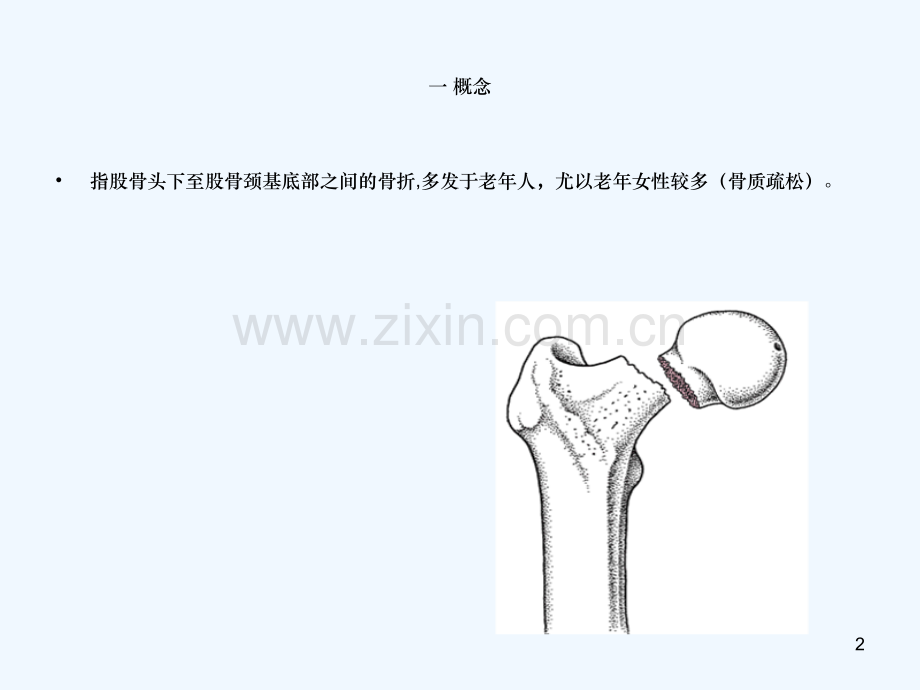 股骨颈骨折的护理中西结合.ppt_第2页