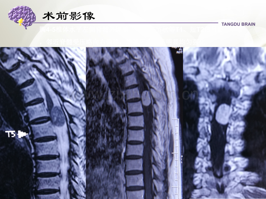 神经鞘瘤与脊膜瘤鉴别诊断(经典).ppt_第3页