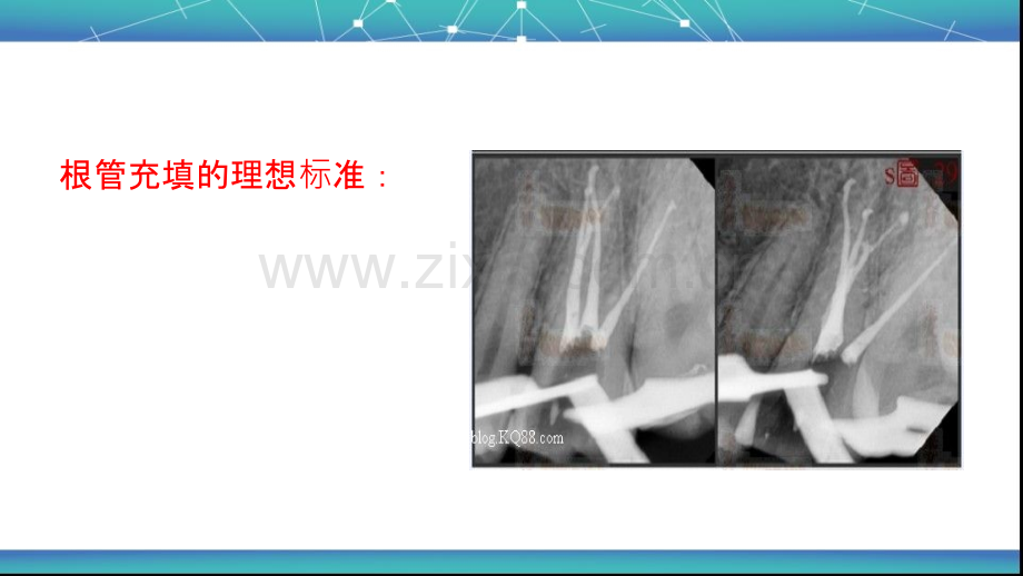 根管治疗术根管充填.ppt_第3页