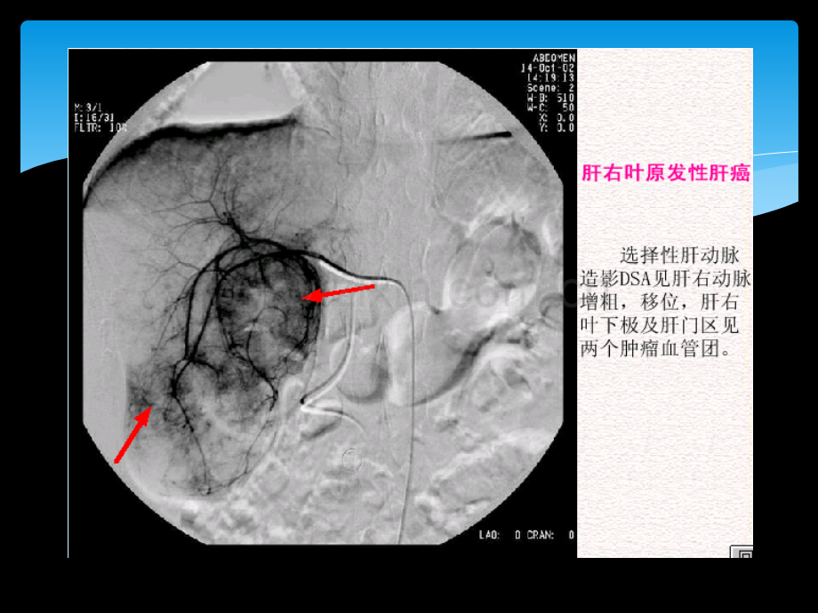 原发性肝癌影像诊断.ppt_第3页