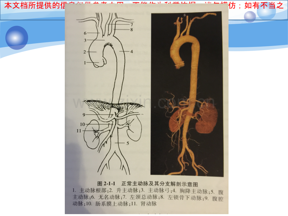 主动脉疾病手术简介培训课件.ppt_第2页