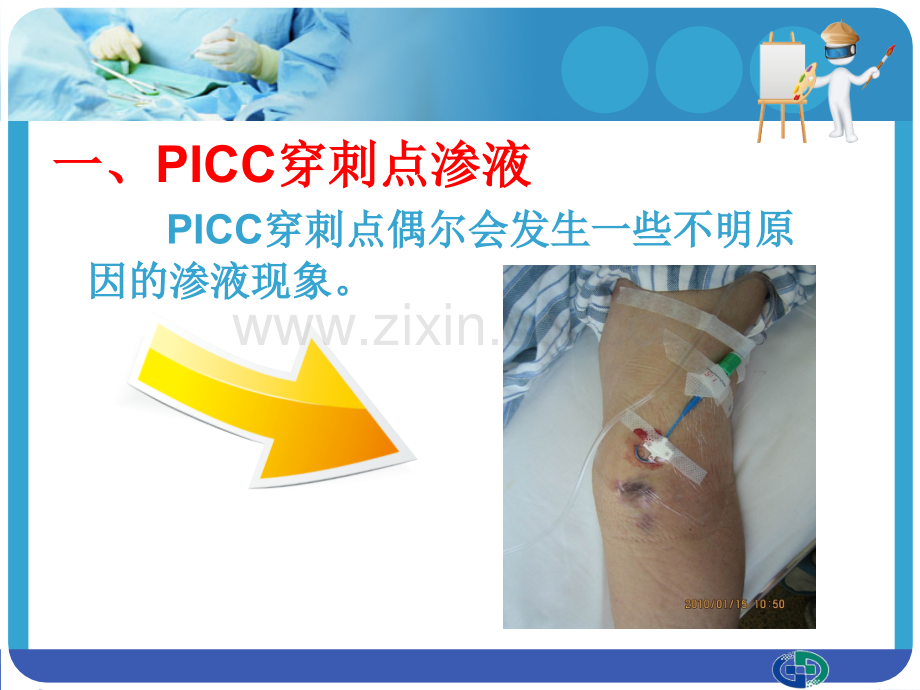 医学PICC穿刺点渗液和皮肤过敏的处置专题课件.ppt_第2页