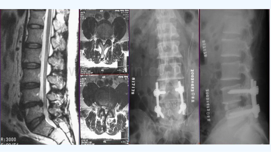 脊柱术后并发症x.ppt_第3页