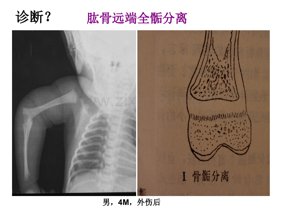 儿童骨骺损伤影像诊疗急讲义.ppt_第2页