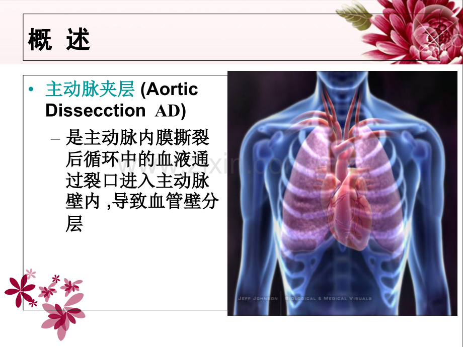 主动脉夹层医疗护理PPT优质课件.ppt_第2页