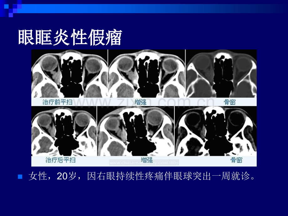 医学五官和颈部典型病例读片PPT培训课件.ppt_第2页