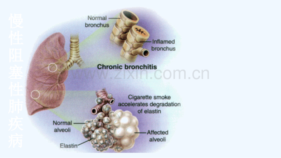 内科护理学呼吸系统COPD.ppt_第3页