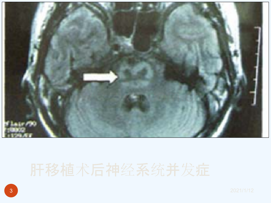 肝移植后神经系统并发症和术中脑功能.ppt_第3页