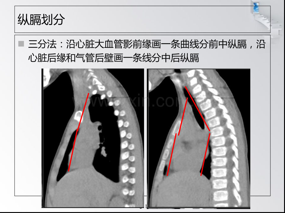 医学中后纵膈疾病诊疗PPT培训课件.ppt_第2页