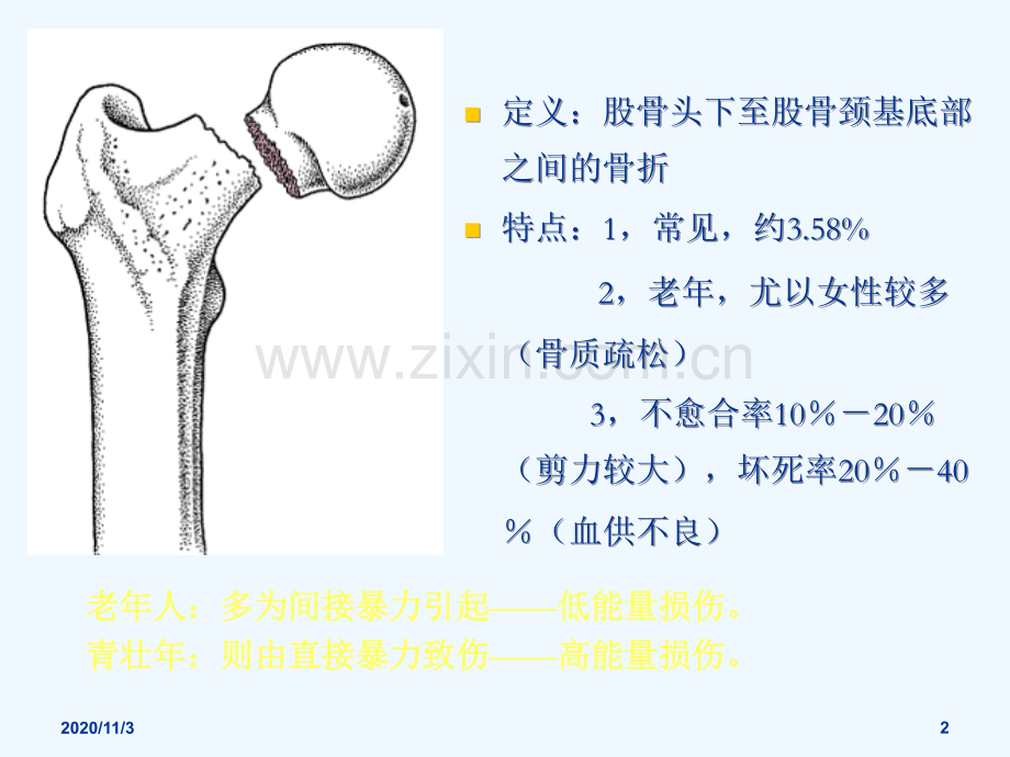 股骨颈骨折朱.ppt_第2页