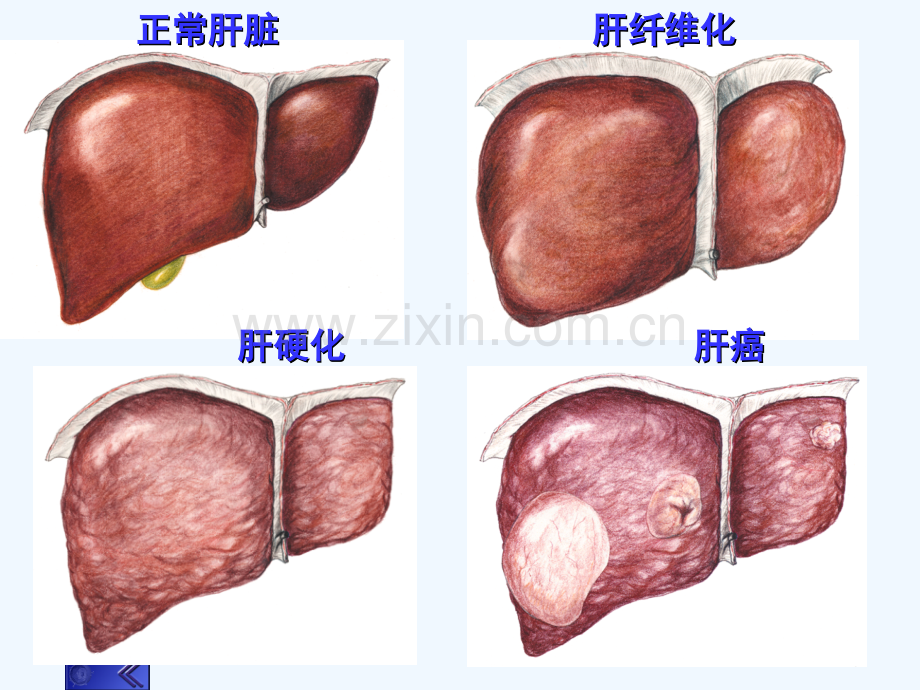 肝硬化的诊断和治疗.ppt_第2页