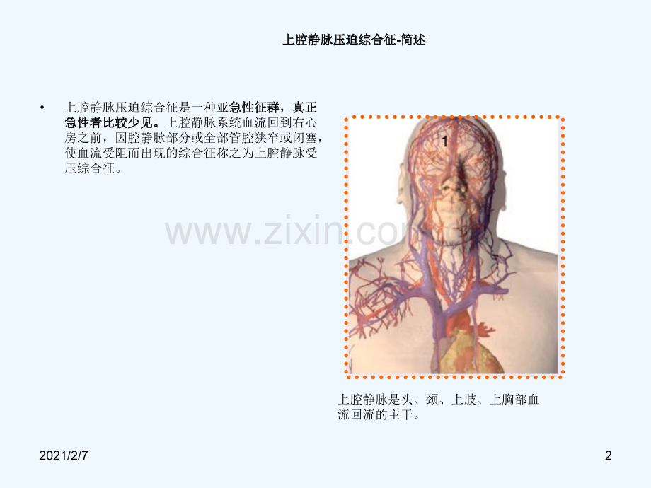 上腔静脉压迫综合征.ppt_第2页