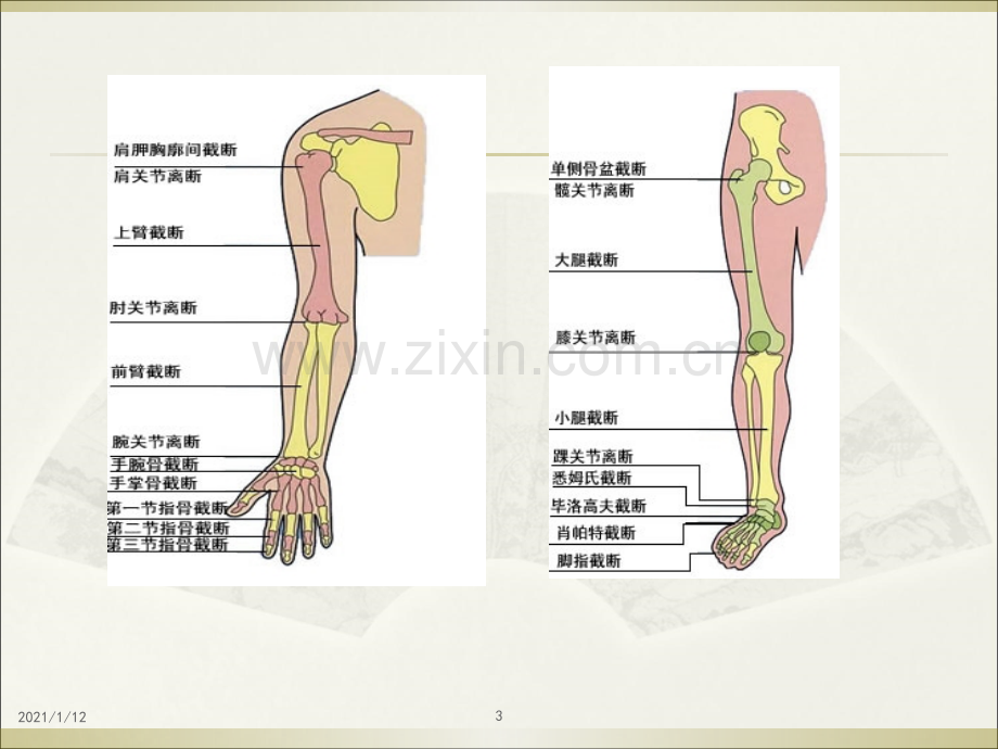 截肢术后VSD护理查房.ppt_第3页