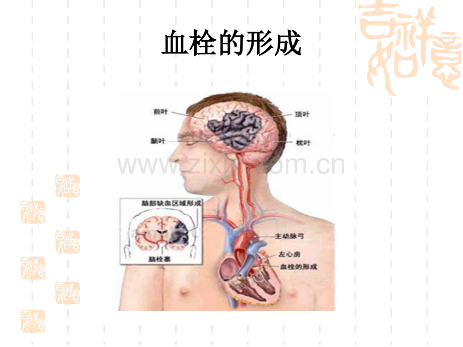 不同部位脑梗的表现-医学课件.ppt_第1页