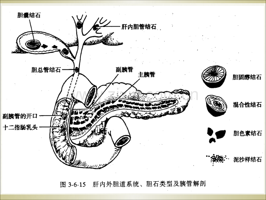 胆道感染和胆石症病人护理.ppt_第3页