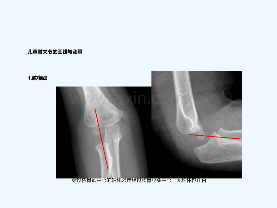 儿童肘关节损伤线诊断.ppt_第2页