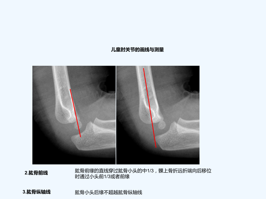 儿童肘关节损伤线诊断.ppt_第3页