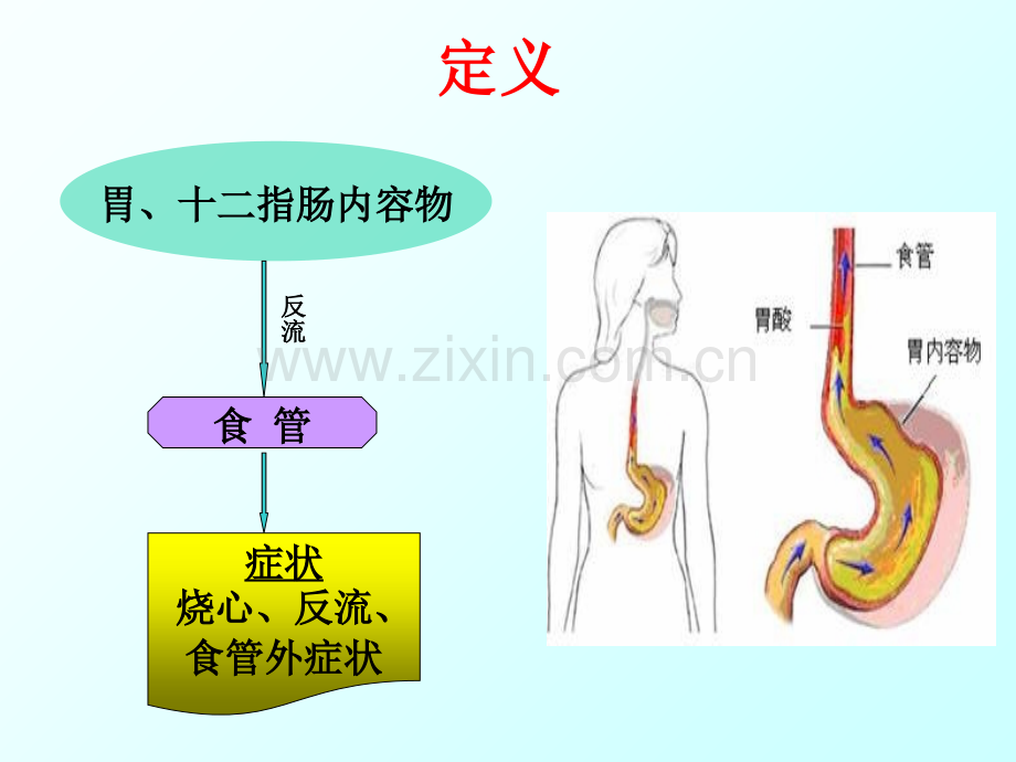 PPT医学课件胃食管反流病健康教育讲义.ppt_第3页