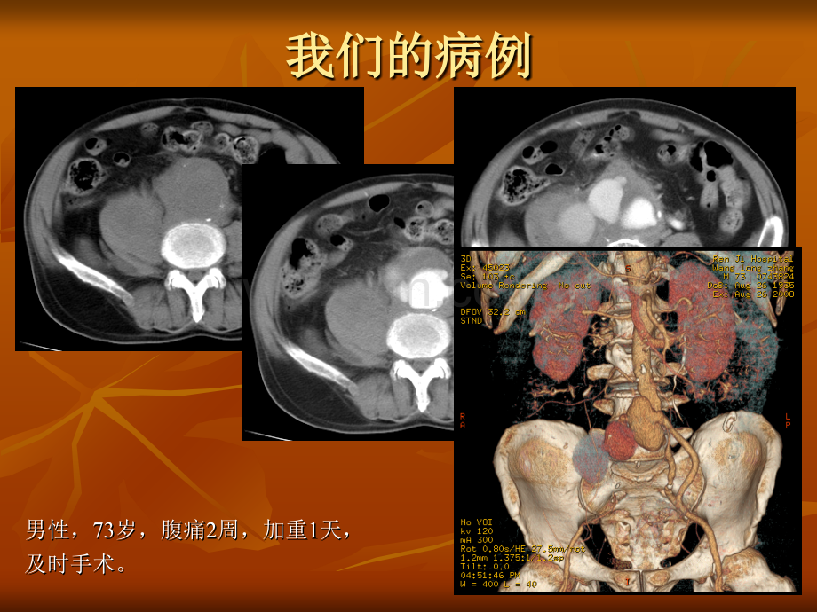 腹主动脉瘤破裂及先兆破裂的CT表现.ppt_第2页