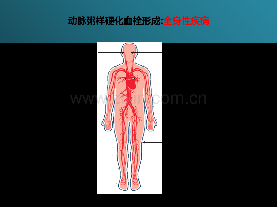 ASCVD时代总体心血管风险评估工具的更新.ppt_第3页