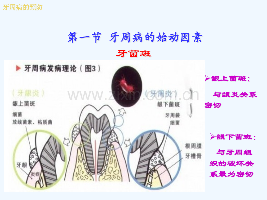 牙周病预防及刷牙.pptx_第3页