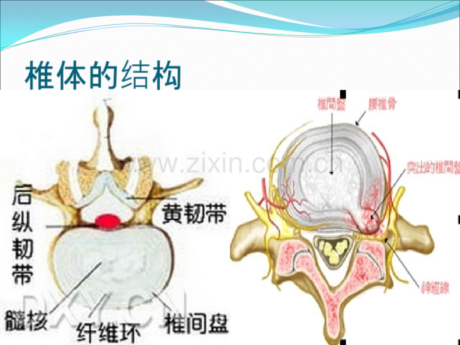 PPT医学课件腰椎间盘突出症病人的护理讲义.ppt_第3页