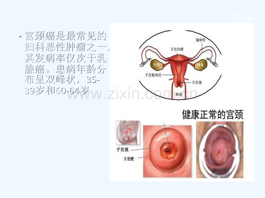 宫颈癌手术配合及注意事项.ppt_第3页