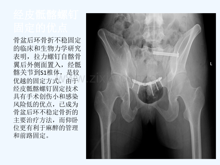 仰卧位C臂透视下经皮骶髂螺钉固定治疗骶髂关节损伤概要.ppt_第2页