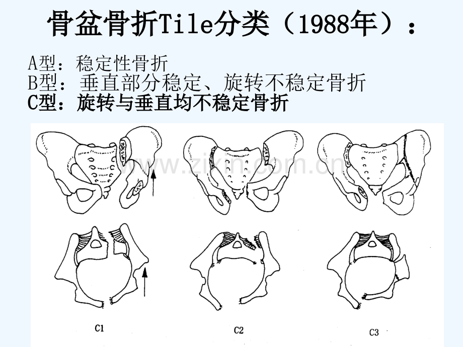 仰卧位C臂透视下经皮骶髂螺钉固定治疗骶髂关节损伤概要.ppt_第3页