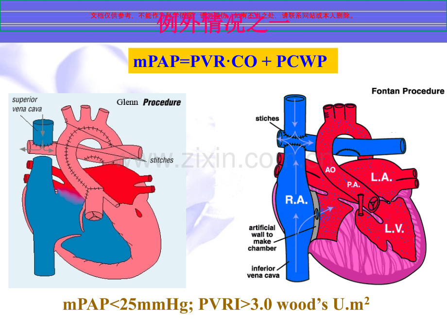 儿童肺动脉高压的特点课件.ppt_第3页