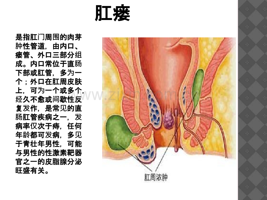 PPT医学课件肛瘘护理查房讲义.ppt_第2页