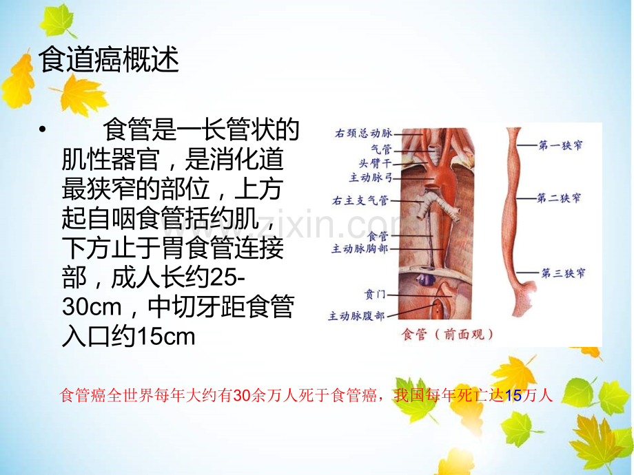 食道癌术后并发症.ppt_第2页