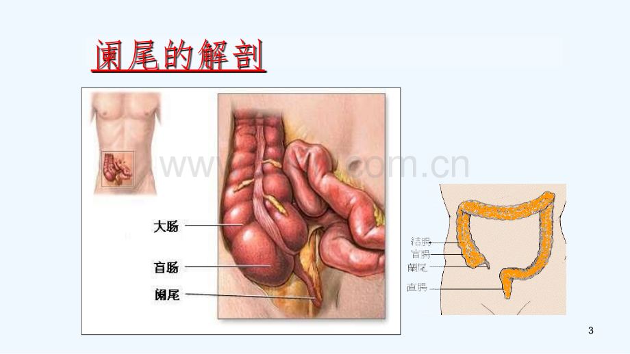 阑尾切除术手术护理配合.ppt_第3页