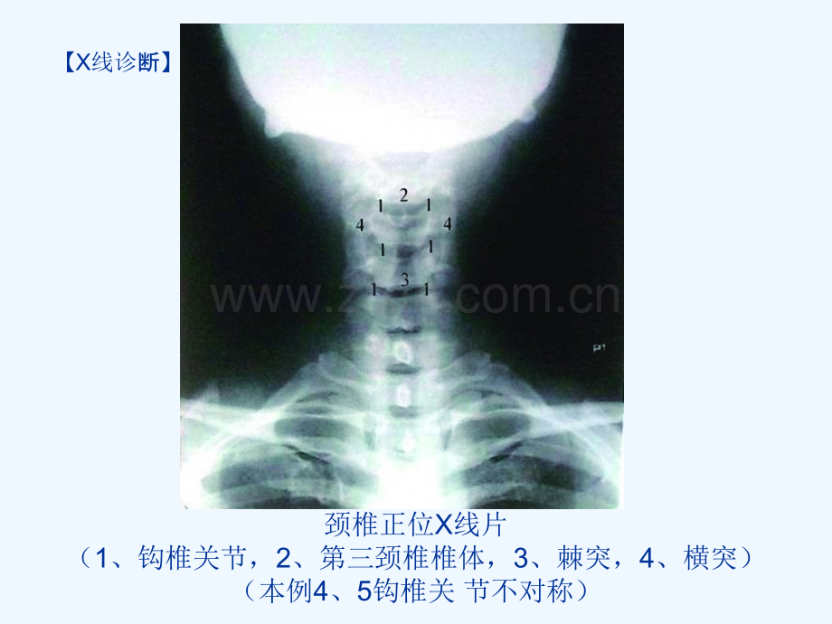 脊柱的影像学诊断.ppt_第2页