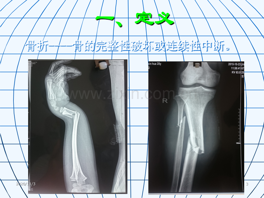 骨折概论课件.ppt_第3页