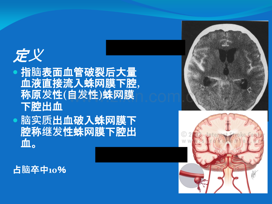 蛛网膜下腔出血诊治流程.ppt_第2页