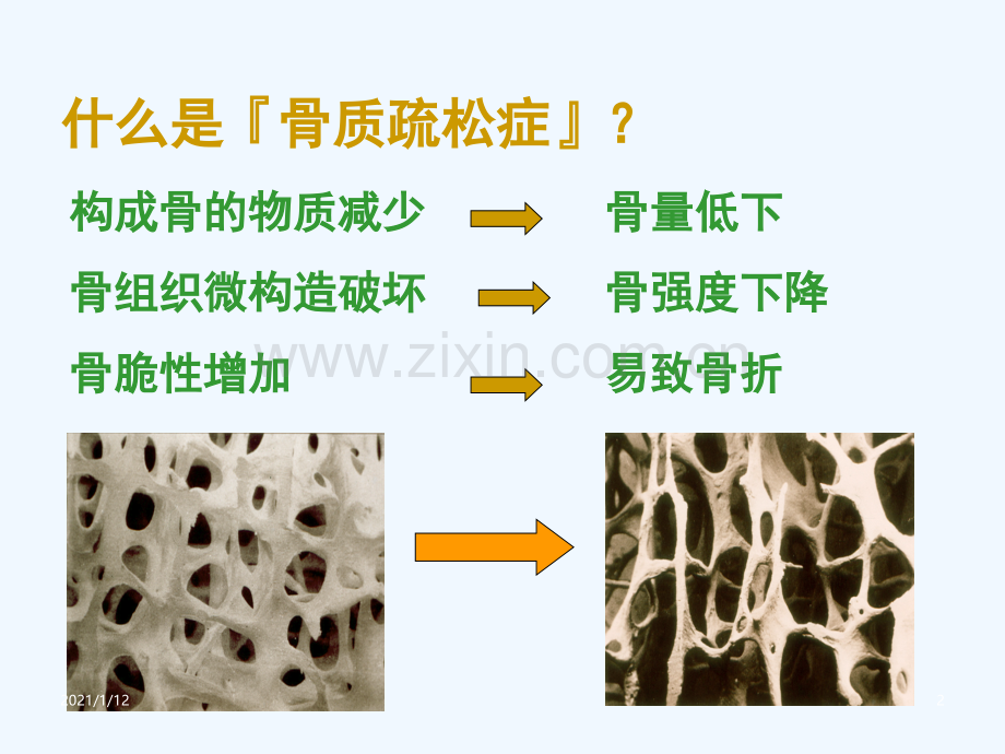 骨质疏松症诊治及预防.ppt_第2页