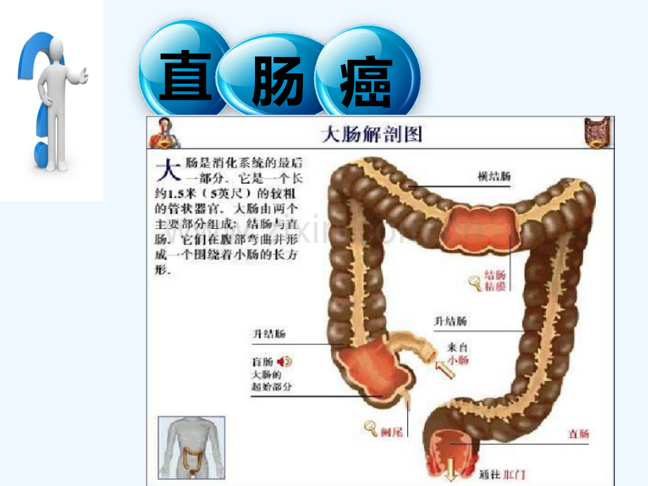 直肠癌护理查房.pptx_第2页