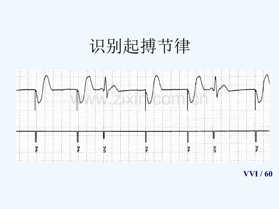 单腔起搏器的相关技术与临床心电图表现.ppt_第3页