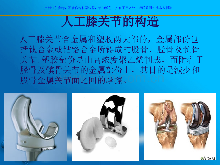 人工全膝关节置换术主题讲座课件.ppt_第3页