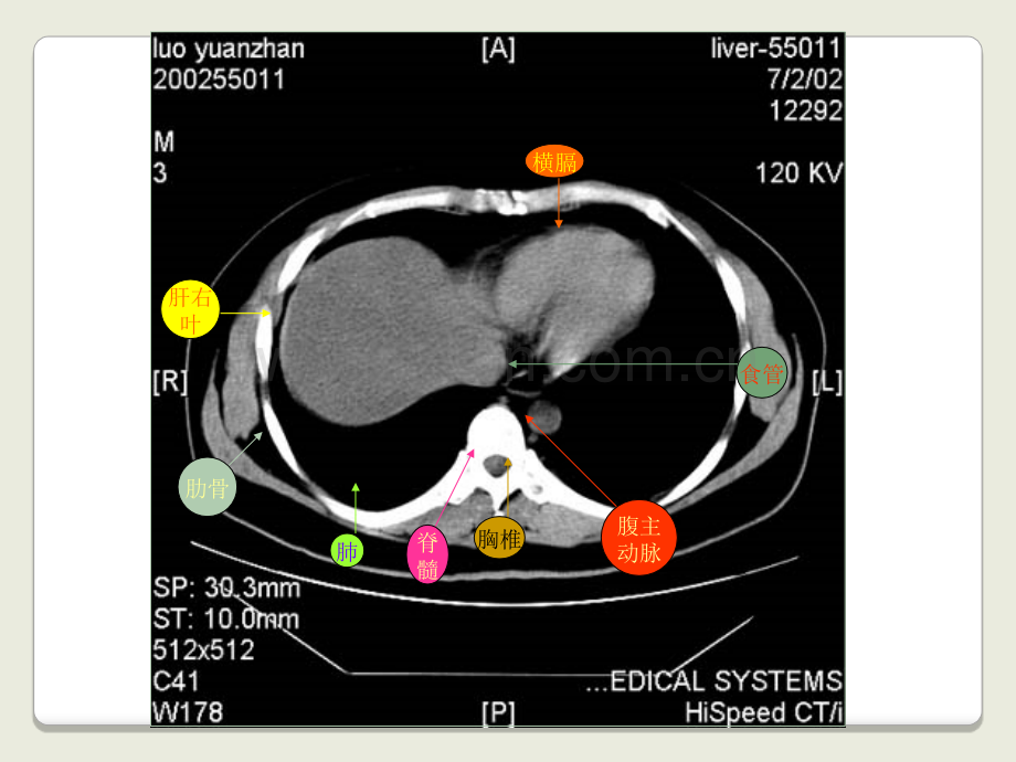 医学上腹部CT基础图解专题课件.ppt_第2页
