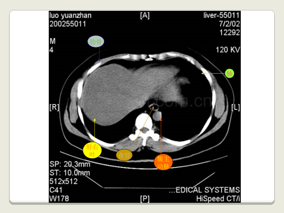 医学上腹部CT基础图解专题课件.ppt_第3页