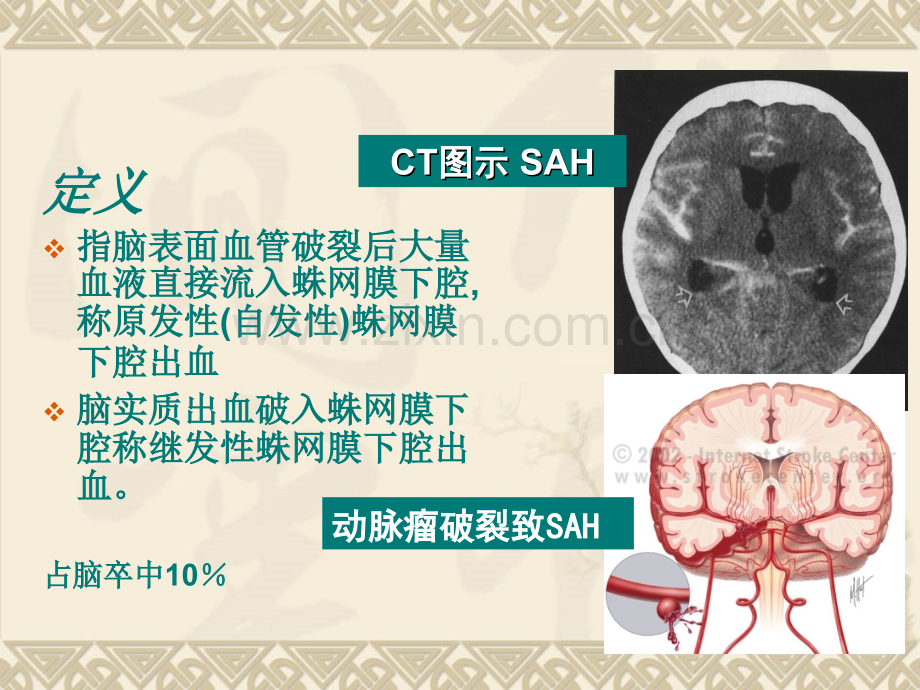 PPT医学课件蛛网膜下腔出血讲解讲义(2).ppt_第1页