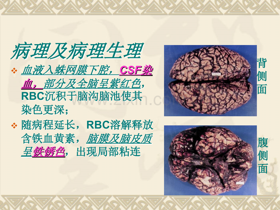 PPT医学课件蛛网膜下腔出血讲解讲义(2).ppt_第3页