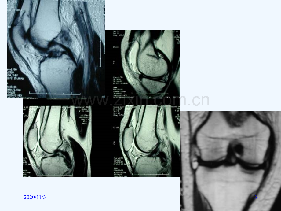 影像学骨关节创伤退行性变及骨肿瘤的MR诊断及相关比较影像学.ppt_第3页