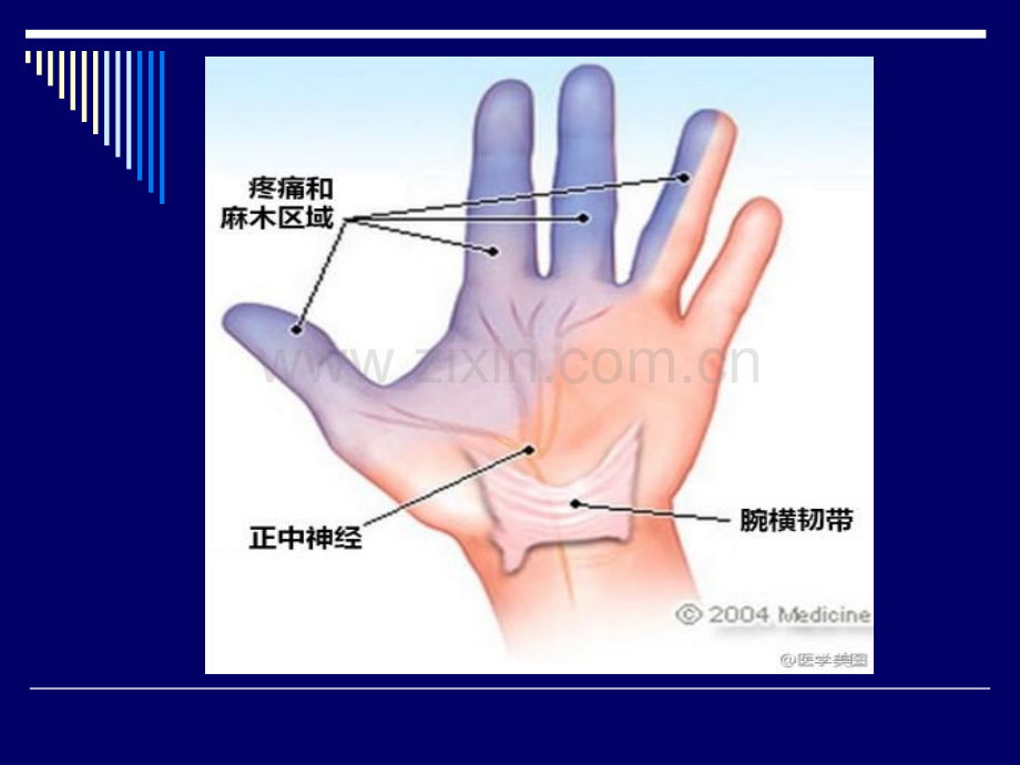 PPT医学课件超声引导下治疗腕管综合症讲义.ppt_第2页