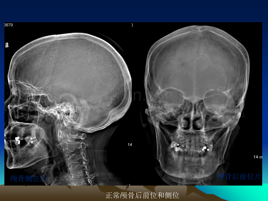 医学中枢神经系统影像学表现PPT培训课件.ppt_第3页