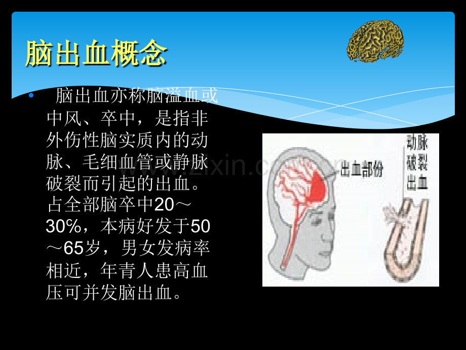 脑出血病人护理查房1.ppt_第3页