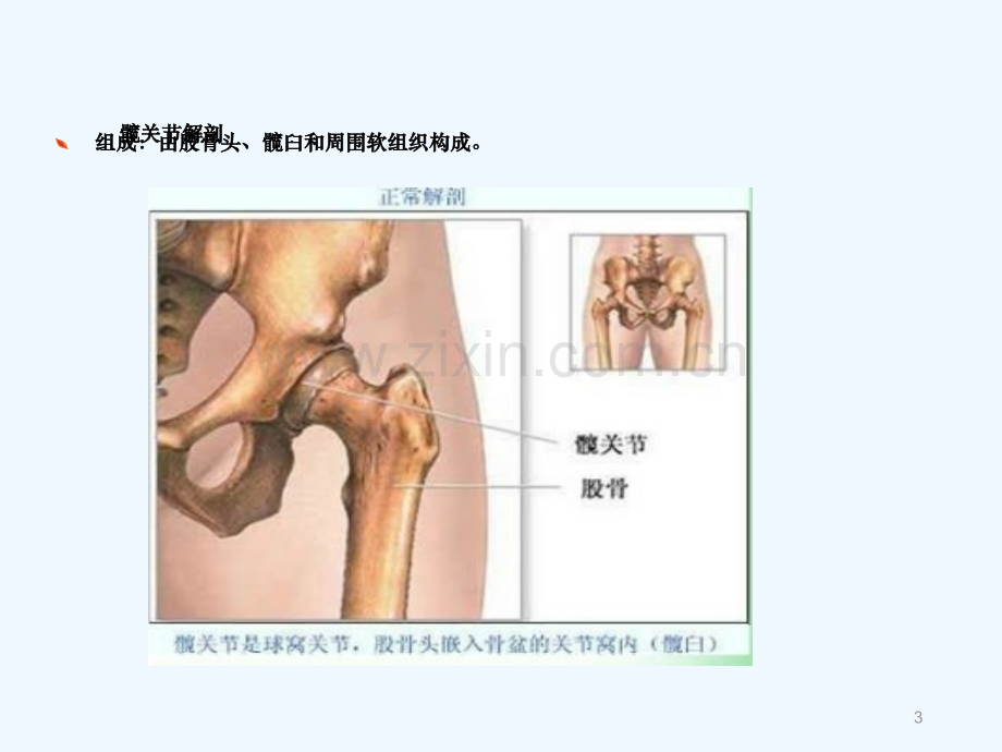 全髋关节置换术后护理.ppt_第3页