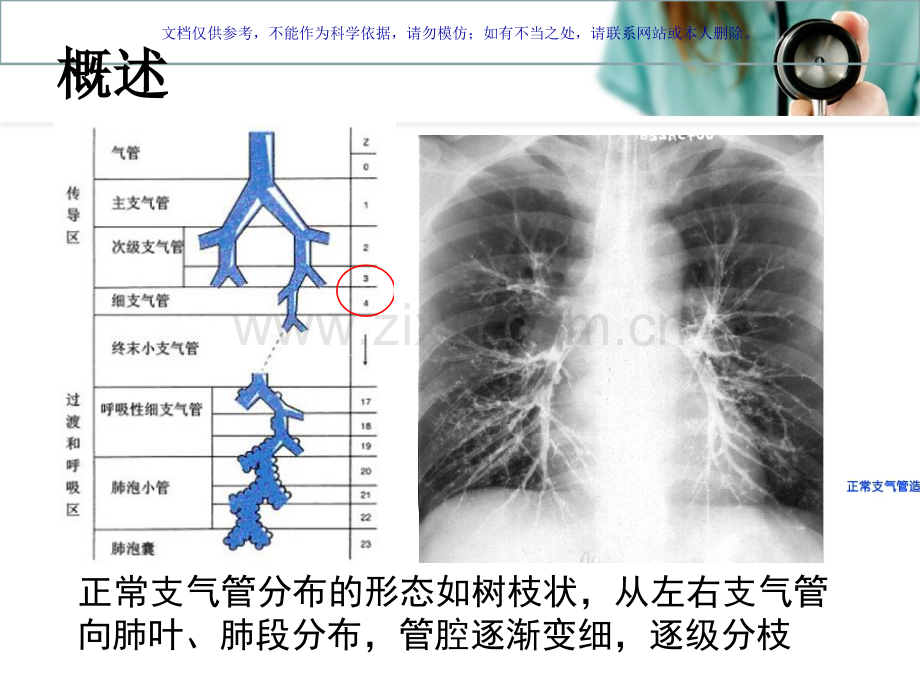 儿童支气管扩张课件.ppt_第2页